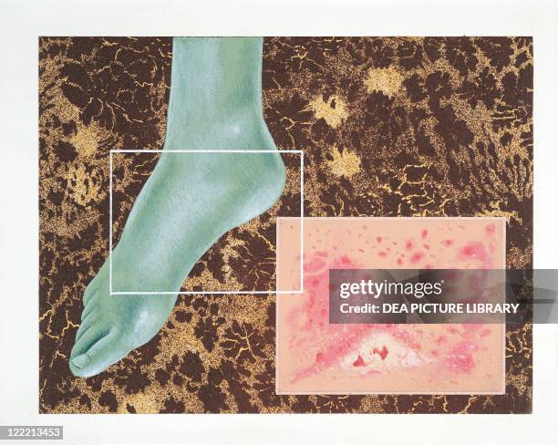 Medicine - Pathology - Foot suffering from Athlete's Foot, a mycosis caused by fungi called Trichophyton or belonging to the genus Epidermophyton,...