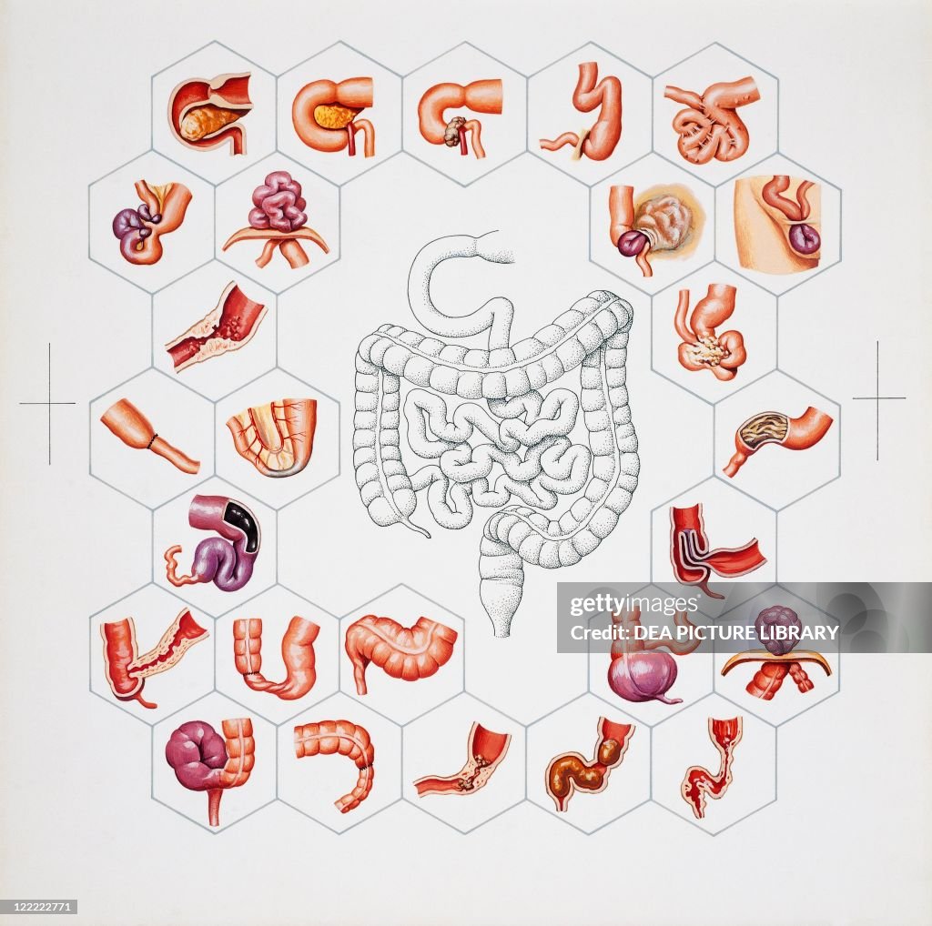 Medical illustration of Digestive system, Intestinal stenosis: examples of most common pathologies, drawing