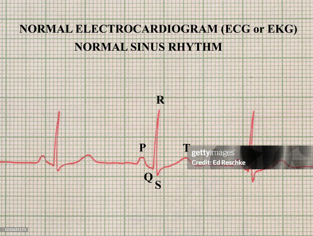 Normal Electrocardiogram Normal Sinus Rhythm High-Res Stock Photo ...