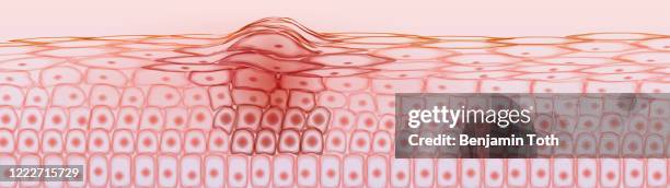 ilustrações de stock, clip art, desenhos animados e ícones de skin tissue cancerous cells, melanoma - pele humana