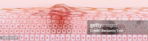 skin tissue cancerous cells, melanoma - human skin cross section stock illustrations