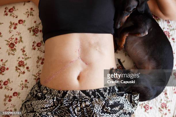 mujer inclinada dow mostrando sus cicatrices de trasplante de hígado - transplant surgery fotografías e imágenes de stock