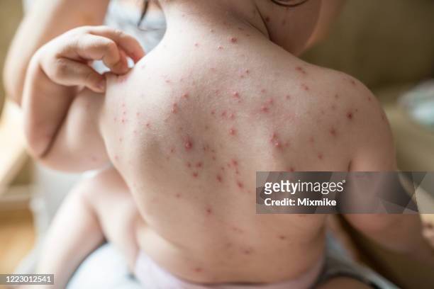 toddler scratching chickenpox rash on her shoulder - blister stock pictures, royalty-free photos & images