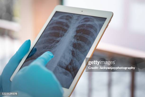 doctors examining x-ray of chest and ribs on digital tablet - person screened for cancer stock pictures, royalty-free photos & images