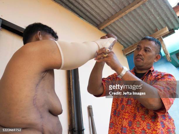 Aria Permana, 13 years old, who previously weighed 192 kilograms with the help of his father wearing special clothes to tighten the skin at his home...