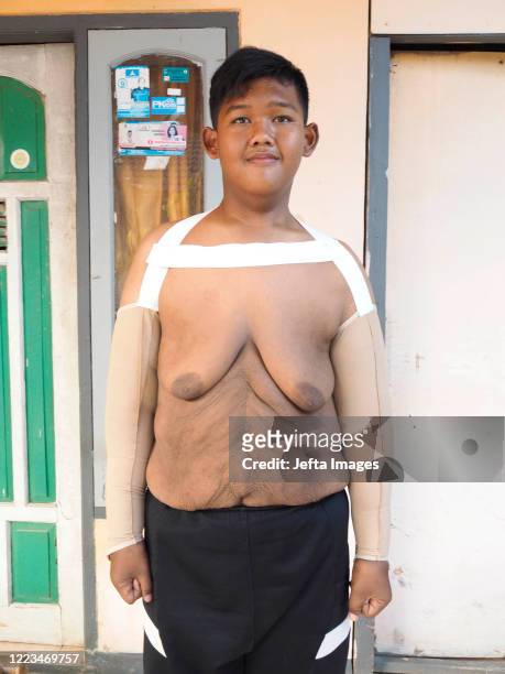 Aria Permana, 13 years old, who previously weighed 192 kilograms with the help of his father wearing special clothes to tighten the skin at his home...