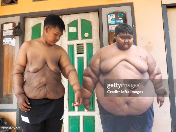 Aria Permana who previously weighed 192 kilograms, showed stitches after the skin removal surgery at his home in Karawang. ONCE known as the heaviest...