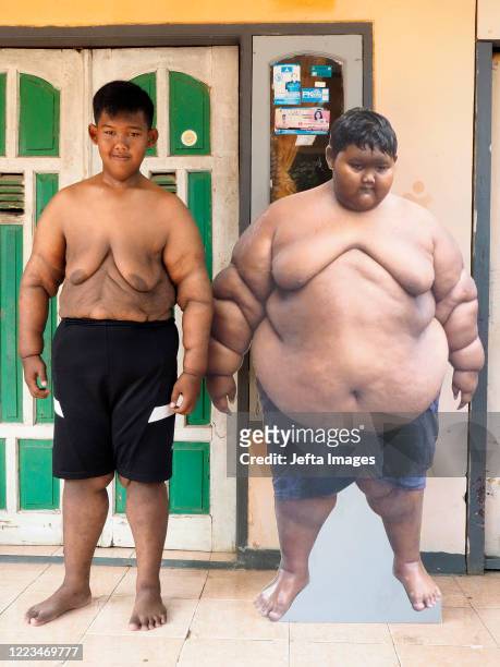 Aria Permana who previously weighed 192 kilograms joked with a replica of his body while he was still obese in front of his house in Karawang. ONCE...