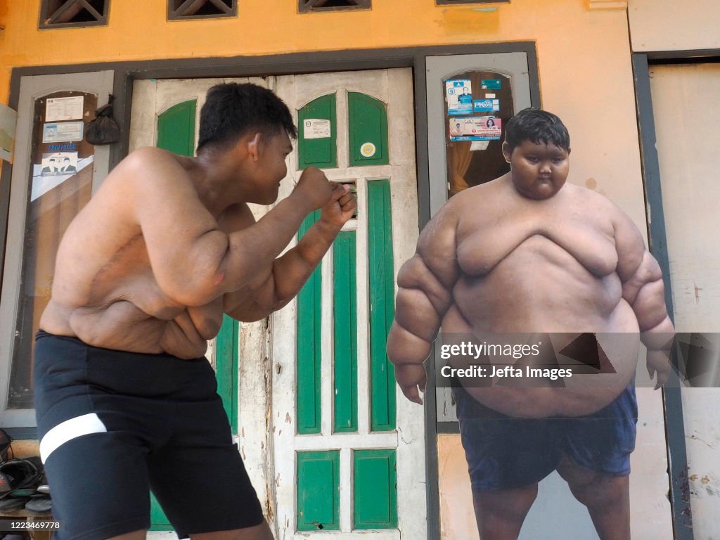 'World's Heaviest Kid' Has Saggy Skin Surgery