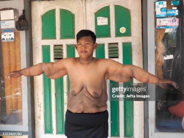 Aria Permana who previously weighed 192 kilograms, showed stitches after the skin removal surgery at his home in Karawang. ONCE known as the heaviest...