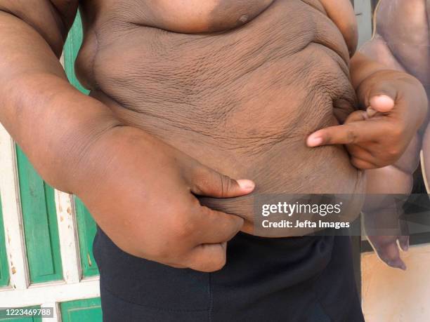 Aria Permana who previously weighed 192 kilograms, showed stitches after the skin removal surgery at his home in Karawang. ONCE known as the heaviest...