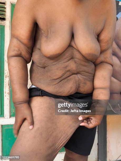 Aria Permana who previously weighed 192 kilograms, showed stitches after the skin removal surgery at his home in Karawang. ONCE known as the heaviest...