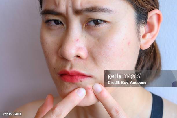 portrait of asian woman pointing acne problem occur on her face. - blackheads stock pictures, royalty-free photos & images