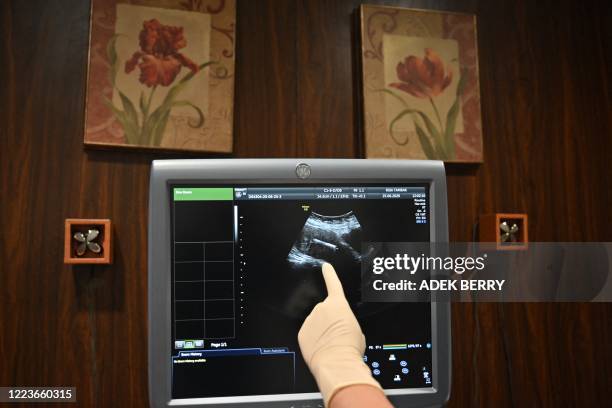 This picture taken on June 25, 2020 shows a doctor pointing at a USG screen with an IUD birth control device inside a patient's womb at a clinic in...