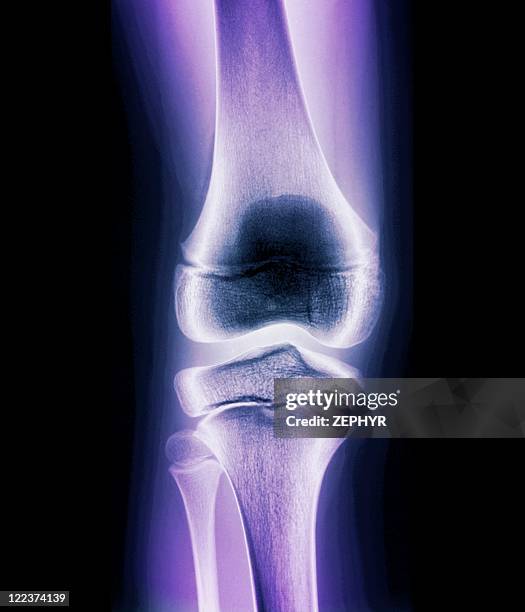 Normal Knee Development Normal Knee Photos and Premium High Res Pictures - Getty Images