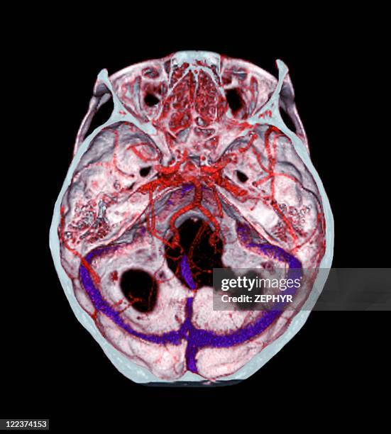 arteries of the brain, 3d ct scan - vaso sanguíneo imagens e fotografias de stock