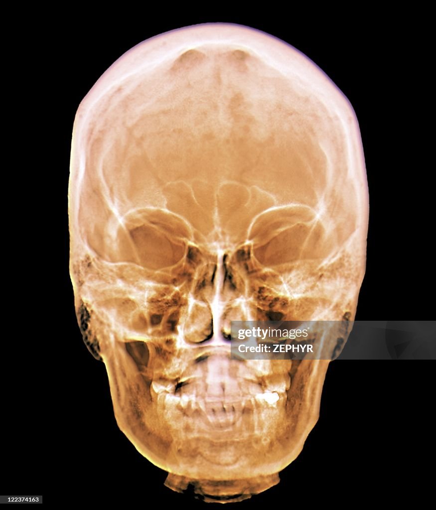 Normal Skull Radiography Normal Skull Xray High-Res Stock Photo - Getty Images