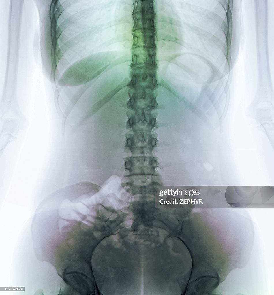 Normal abdomen, X-ray