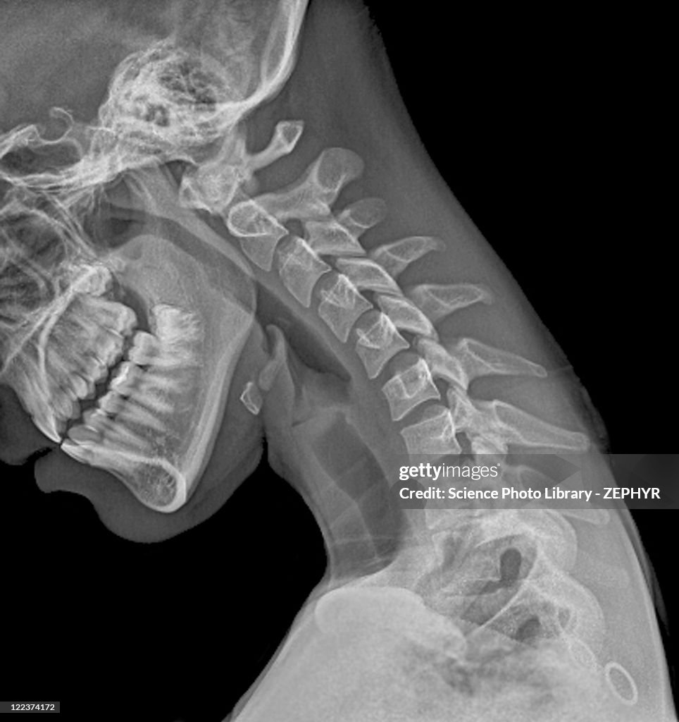 Normal flexed neck, X-ray