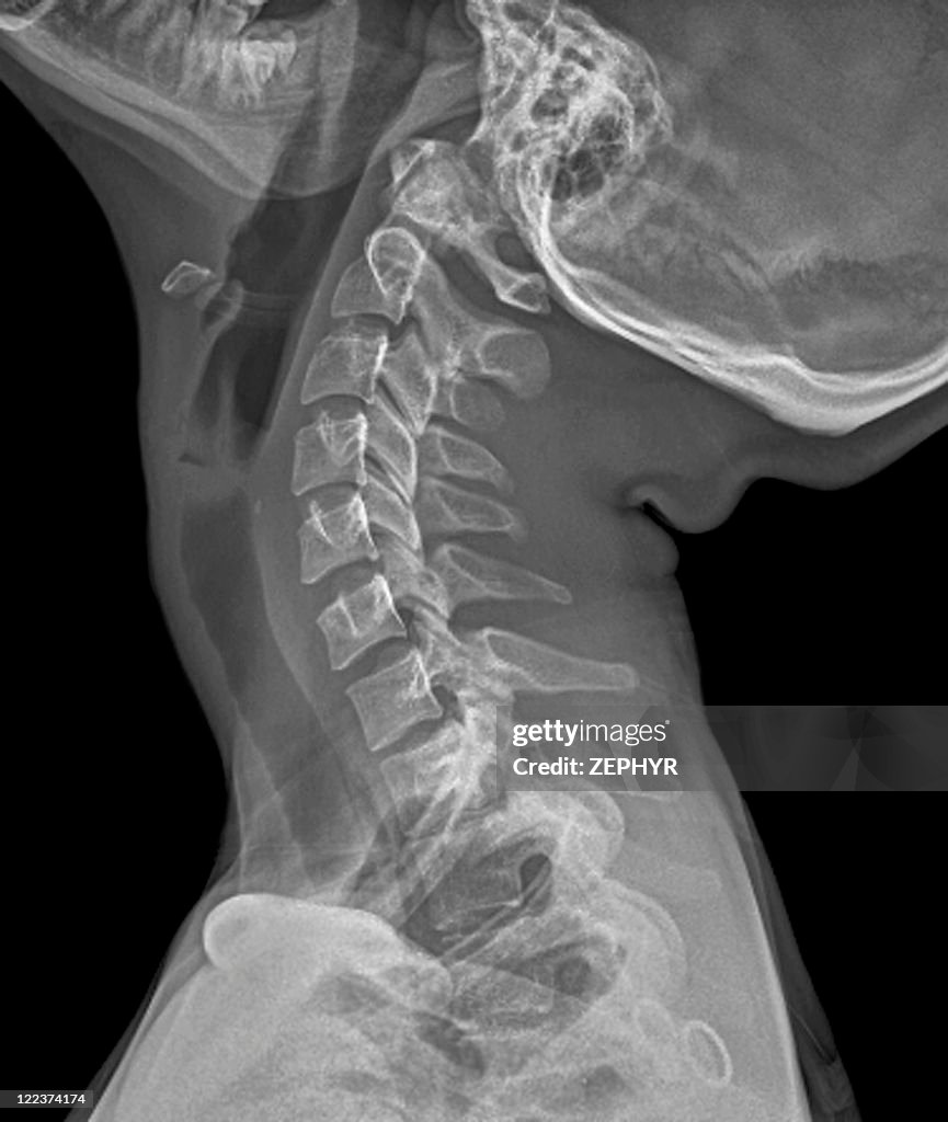 Fish Bone Neck Radiograph Neck Anatomy Lateral Radiography