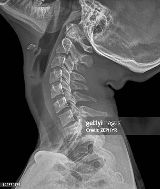 Normal Spine X Ray Photos and Premium High Res Pictures - Getty Images