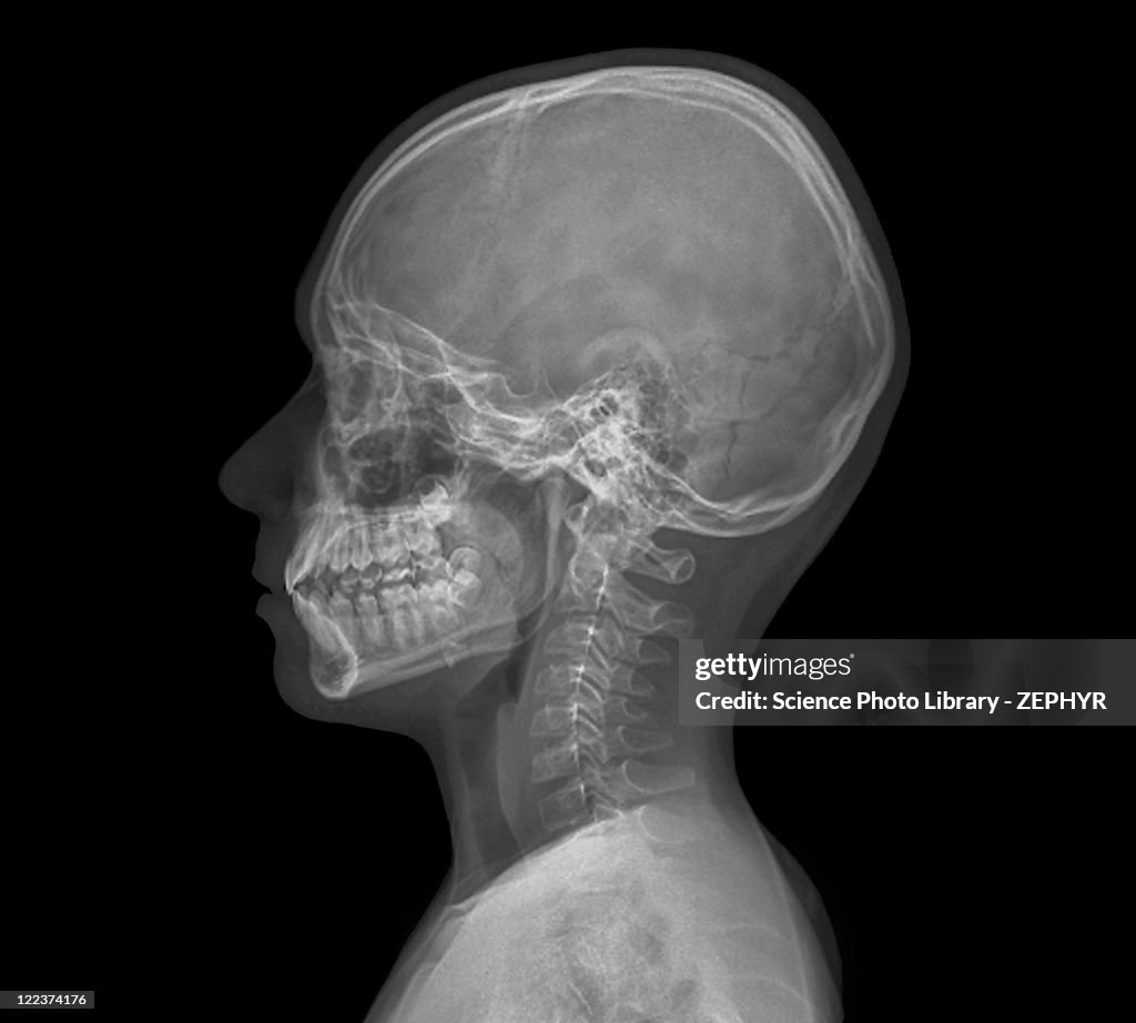 Normal child's head, X-ray