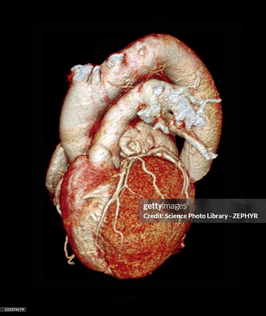 Normal heart, 3D CT scan