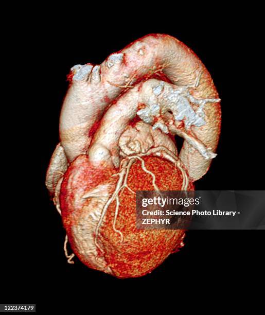 normal heart, 3d ct scan - computerized tomography stock pictures, royalty-free photos & images