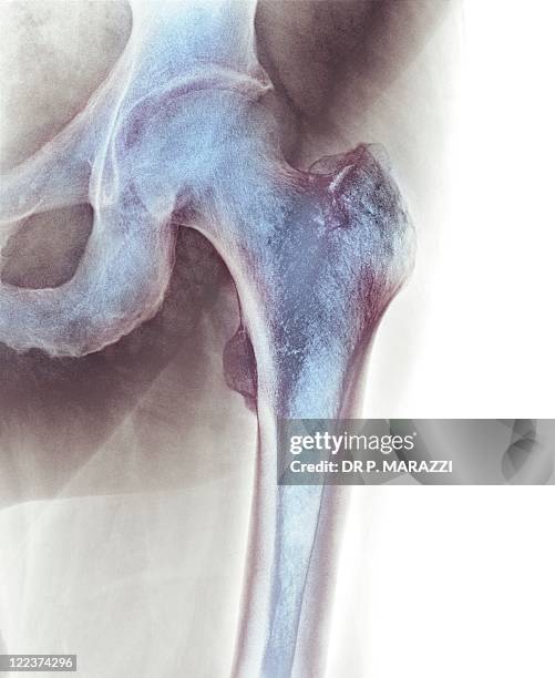 Normal Hip Xray High-Res Stock Photo