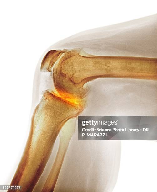 arthritis of the knee, x-ray - inflammation stock pictures, royalty-free photos & images