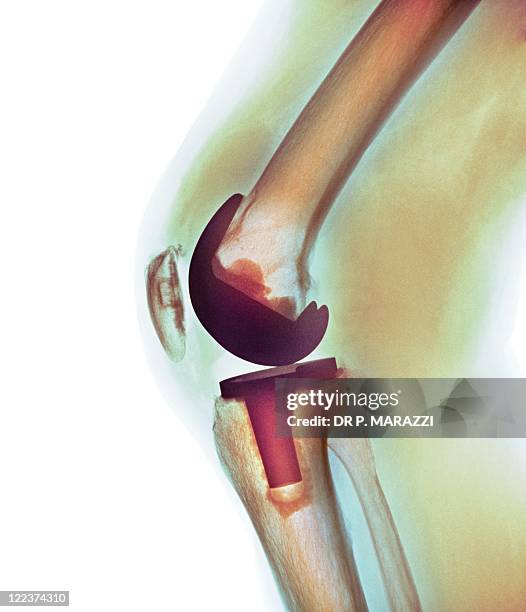 knee replacement, x-ray - künstliches kniegelenk stock-fotos und bilder