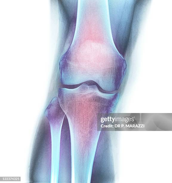 normal knee, x-ray - female likeness stock pictures, royalty-free photos & images