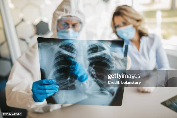 médicos que examinan la radiografía de los pulmones - neumonía fotografías e imágenes de stock