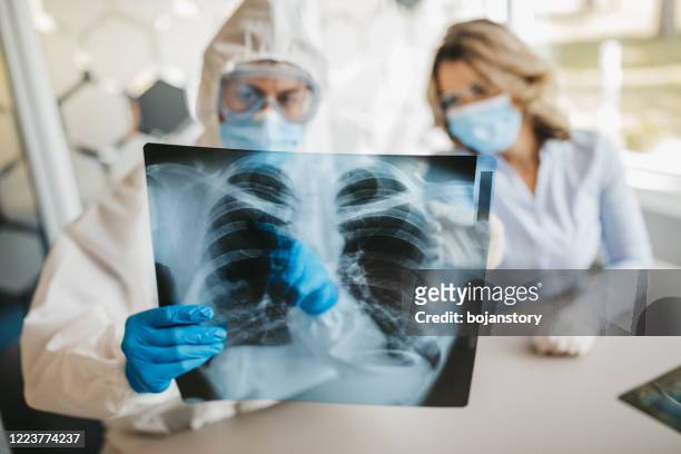 medici che guardano i polmoni a raggi x - malattia infettiva foto e immagini stock