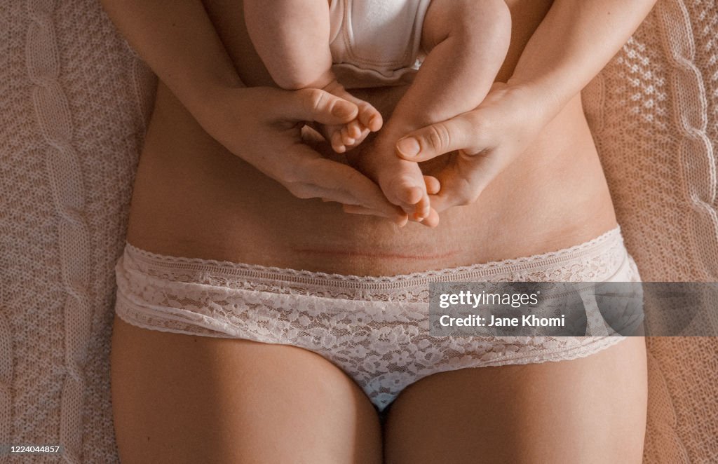 C-section scar and newborn baby