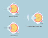 eyeball anatomy, internal organs body part nervous system, astigmatism corrected, eyesight concept