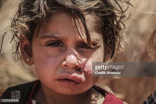 Syrian kid suffering from leishmaniasis, a parasitic disease spread by the bite of phlebotomine sandflies, is seen in a refugee camp in Idlib, Syria...