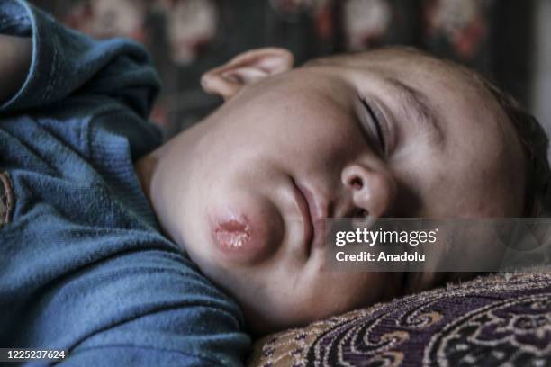 Syrian kid suffering from leishmaniasis, a parasitic disease spread by the bite of phlebotomine sandflies, is seen in a refugee camp in Idlib, Syria...