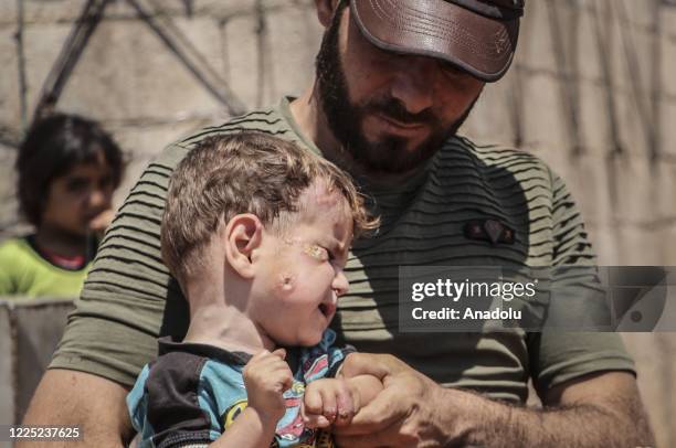 Syrian kid suffering from leishmaniasis, a parasitic disease spread by the bite of phlebotomine sandflies, is seen in a refugee camp in Idlib, Syria...