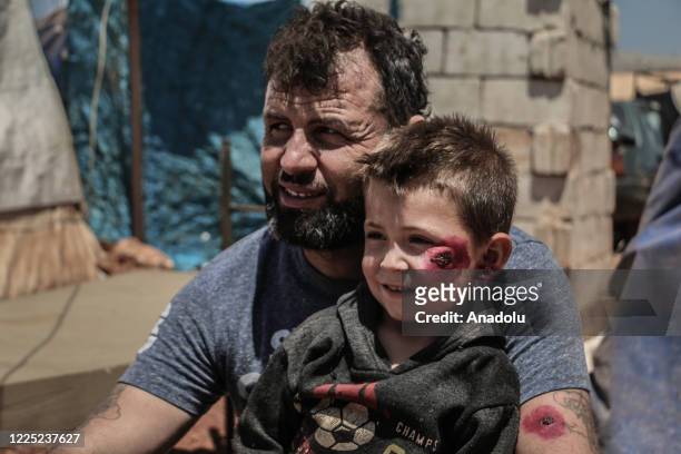 Syrian kid suffering from leishmaniasis, a parasitic disease spread by the bite of phlebotomine sandflies, is seen with his father in a refugee camp...