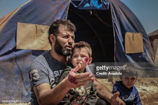 Syrian kid suffering from leishmaniasis, a parasitic disease spread by the bite of phlebotomine sandflies, is seen in a refugee camp in Idlib, Syria...