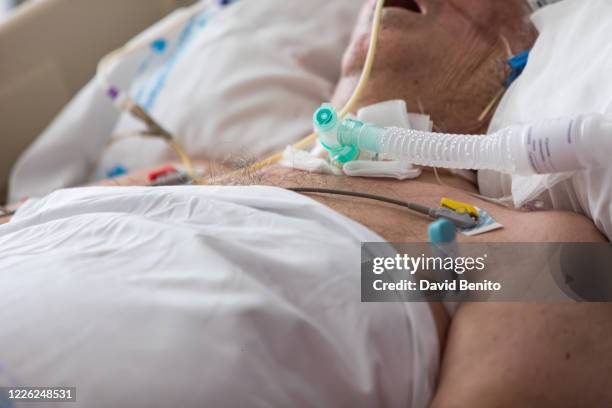 Patient with a tracheostomy lies while connected to a ventilator in the intensive care unit at the Fundacion de Alcorcon University Hospital on May...