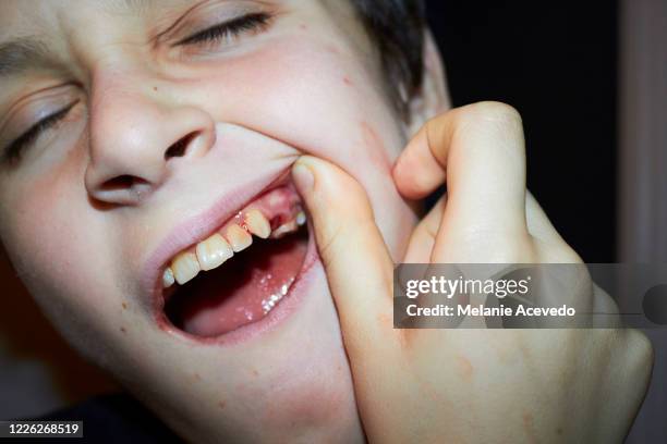 young boy holding up his lip showing his missing bloody tooth to the camera eyes are shut close up - human teeth stock pictures, royalty-free photos & images
