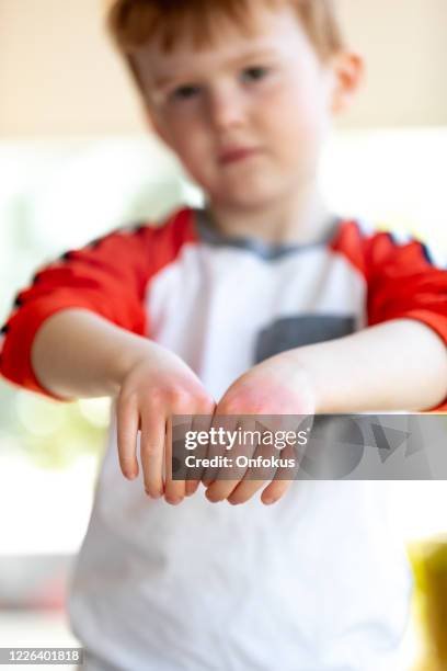 cute kid showing sunburn on his red and dry hands - hand eczema stock pictures, royalty-free photos & images