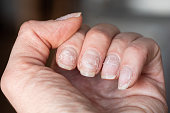 Close-up of brittle nails. Damage to the nail after using shellac or gel polish. Peeling on the nails