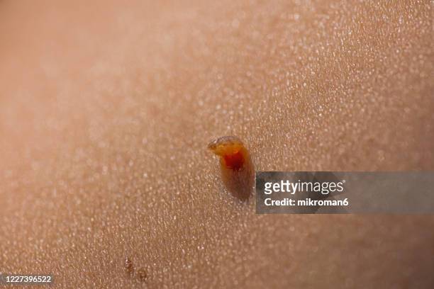 human skin with skin cancer, beauty mark, freckles - warts stock pictures, royalty-free photos & images