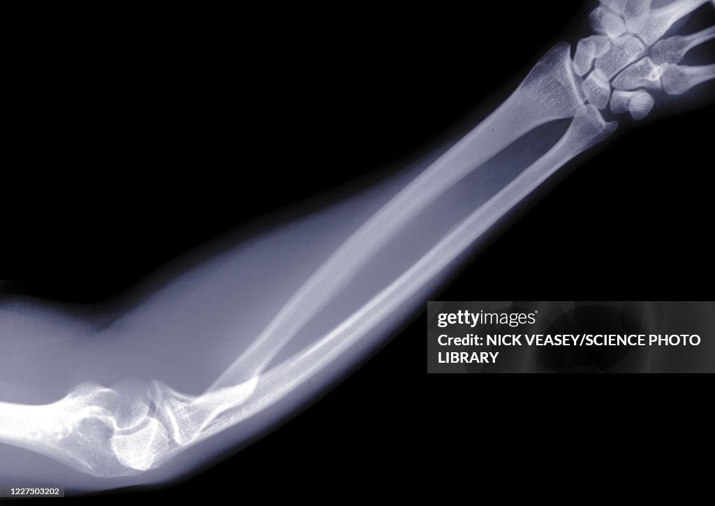 Arm and elbow, X-ray