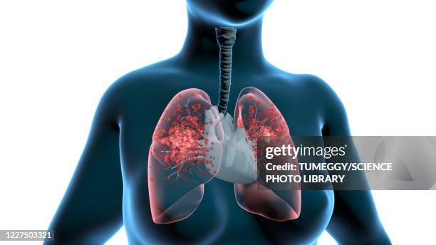 infected lungs, 3d illustration - human internal organs 3d model stock pictures, royalty-free photos & images