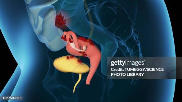 endometriosis, 3d illustration - endometriosis stock-fotos und bilder