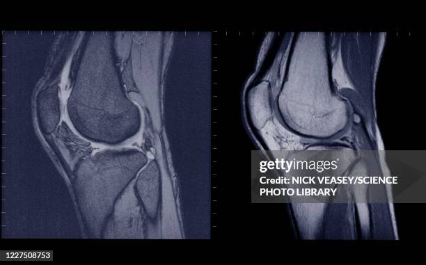 knee joints side view, mri - joint body part stock pictures, royalty-free photos & images